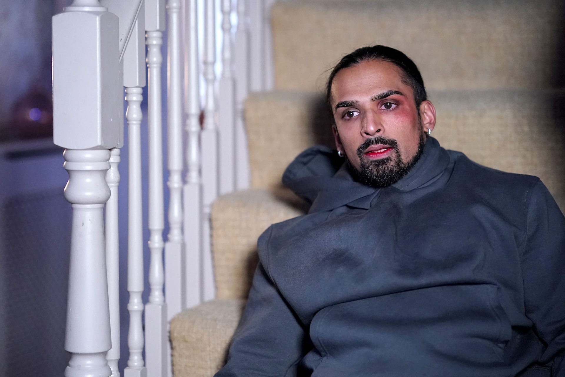 Ravi sports a cut eye