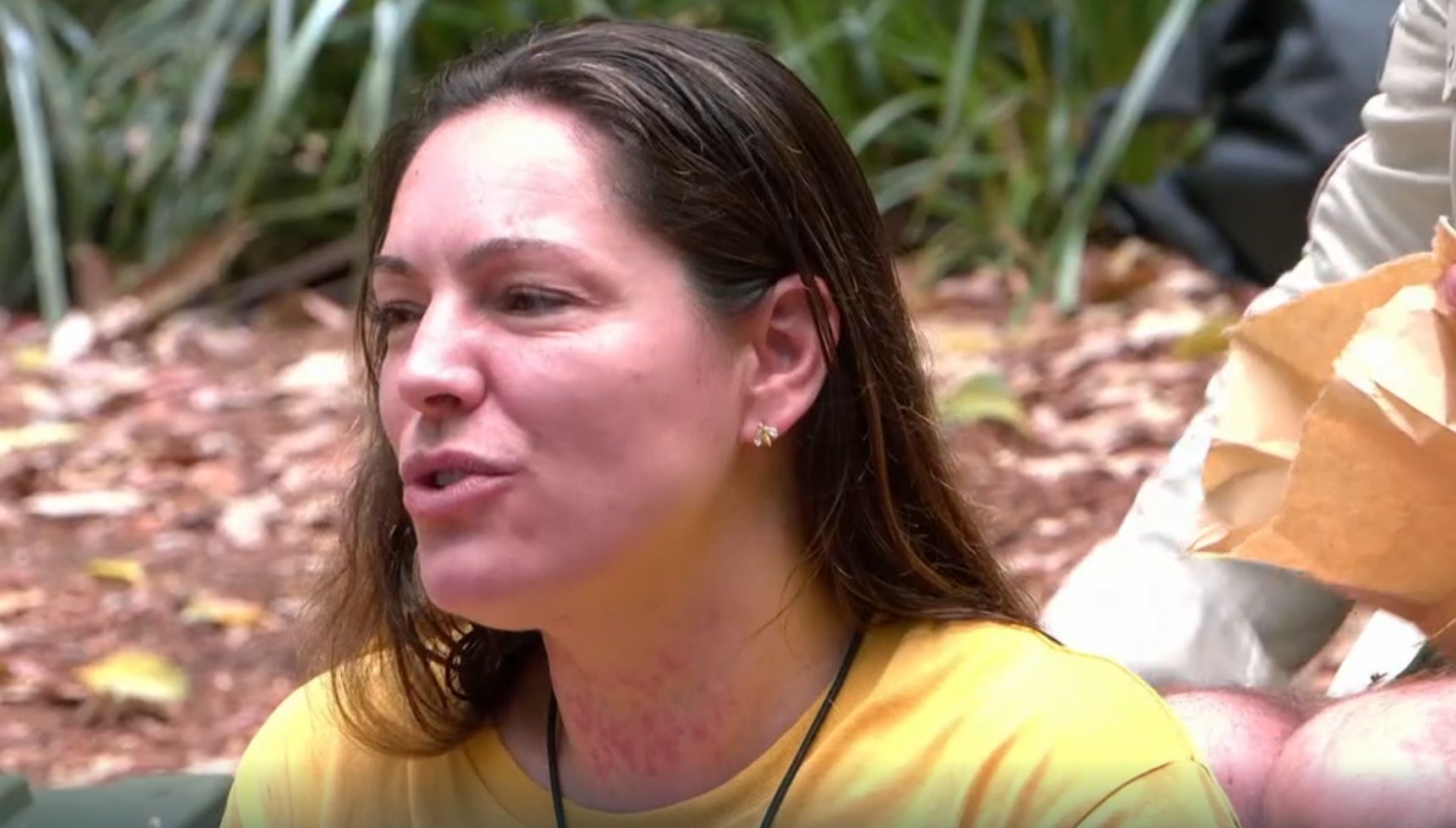 I'm A Celebrity star Kelly Brook sparks concern with neck rash