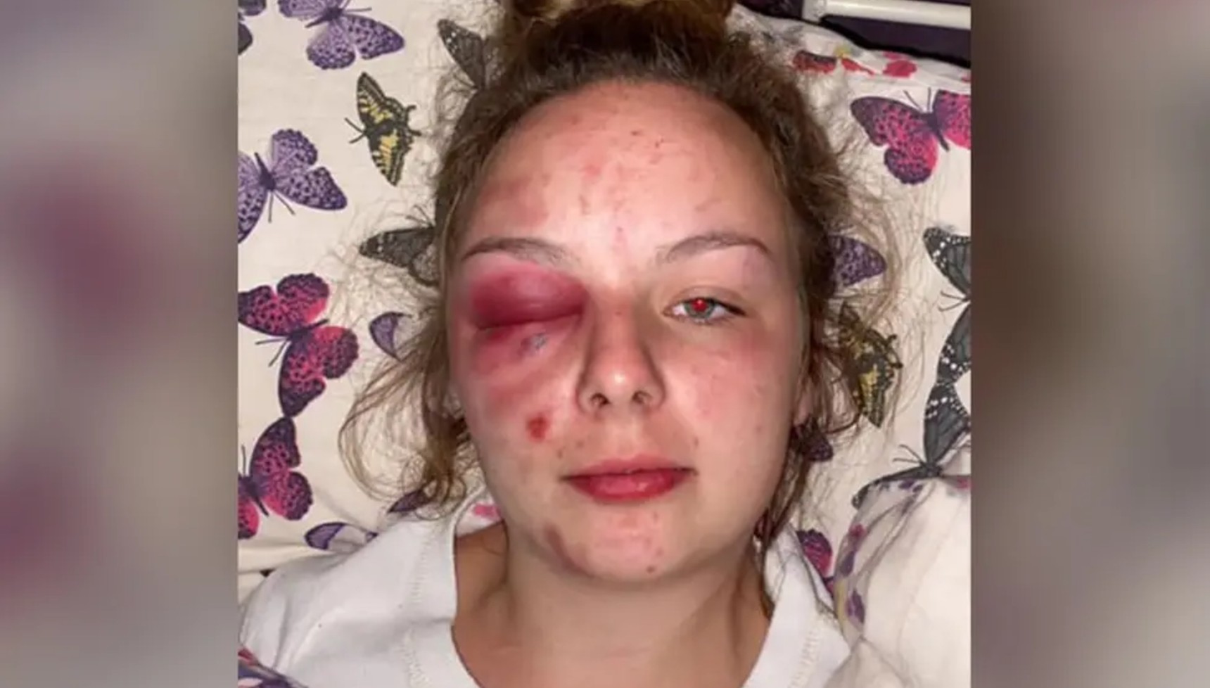Ellie Williams wounds